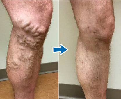 Cvreoz® VenoAid Solución en aerosol para varices