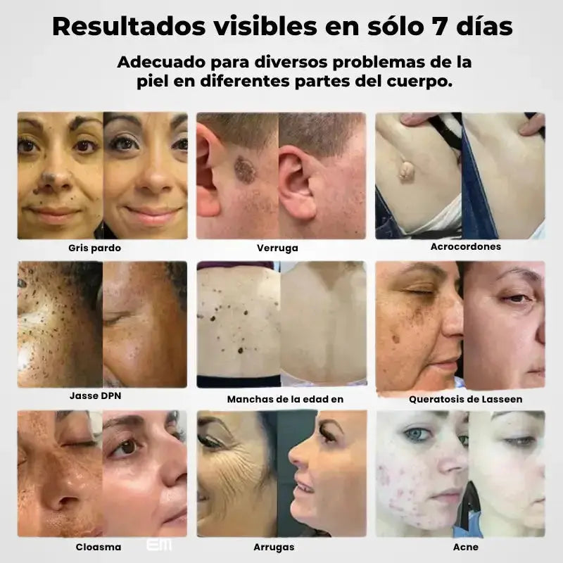 acne (6).webp__PID:436c9bb8-1e26-4c7a-9369-00f8acb4f66c
